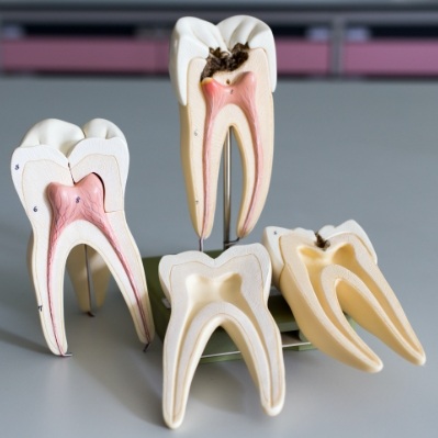 Model healthy tooth and tooth in need of root canal therapy